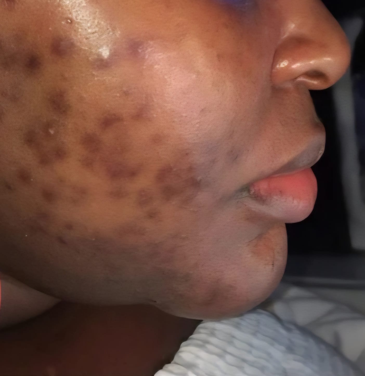 When PCOS Shows Up on Your Skin: Stories of Change and Care - Ireora Skincare